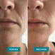 Mund Patches mit Niacinamide 