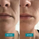 Mouth Patches with Ectoin