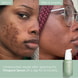 Blemish Control Serum