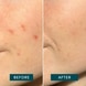 Pimple Patches 
