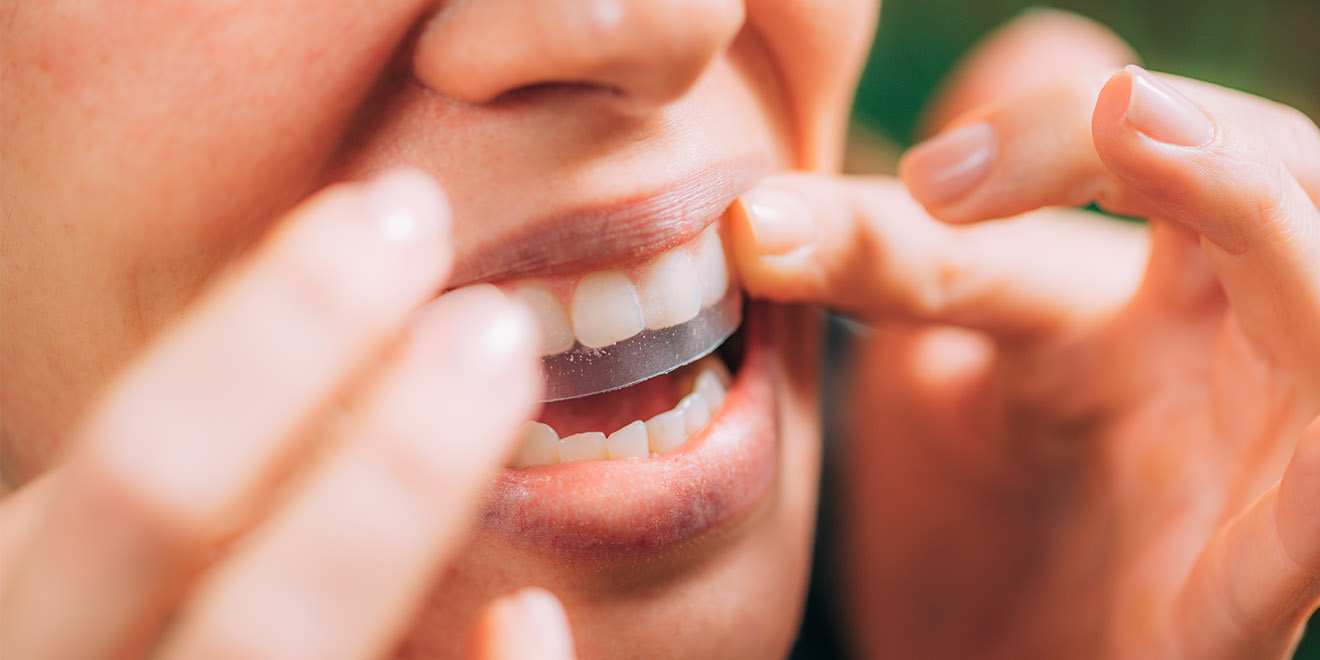 Strisce sbiancanti trasparenti vengono applicate ai denti